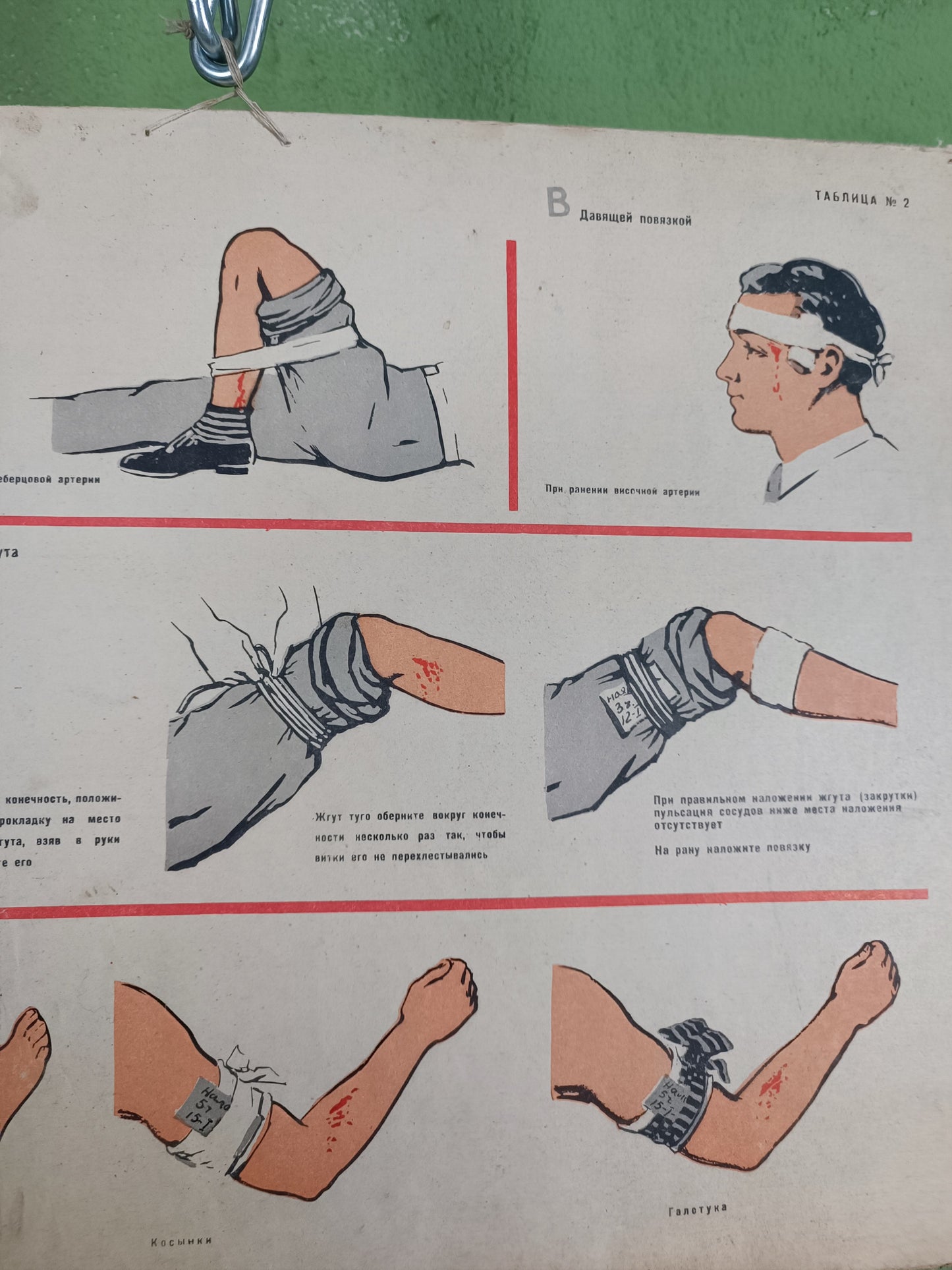 Double Sided Medical Poster. "How to Stop Temporary Bleeding"