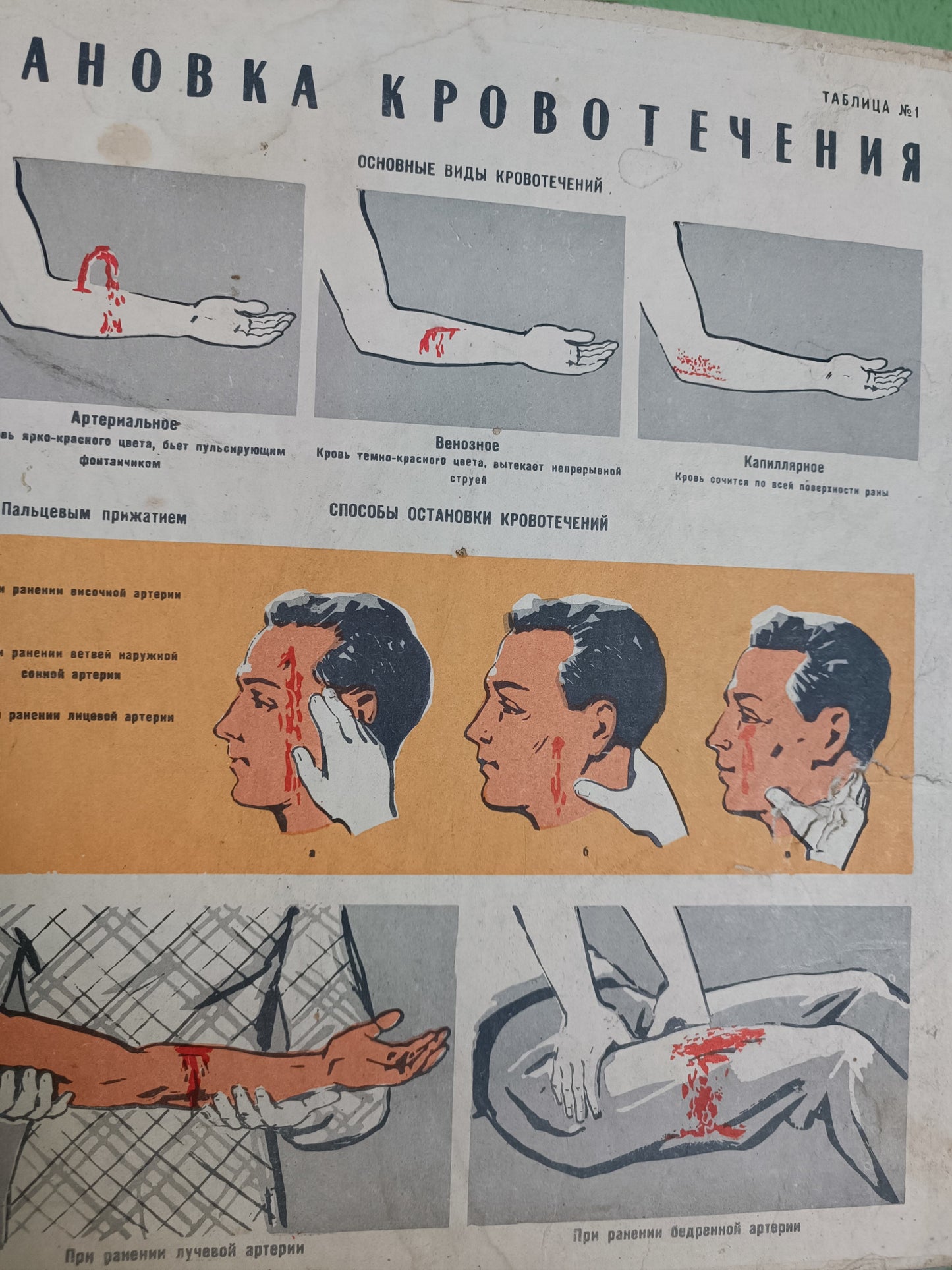 Double Sided Medical Poster. "How to Stop Temporary Bleeding"